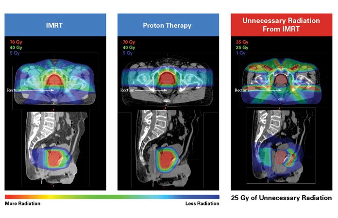 Prostate Cancer Proton Beam Therapy