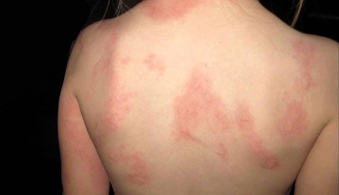 severe-case-of-hives-health-and-fitness-pinterest-urticaria