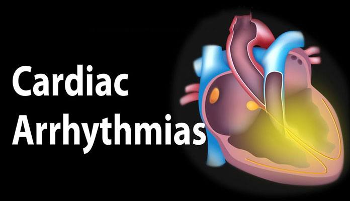 arrhythmia causes
