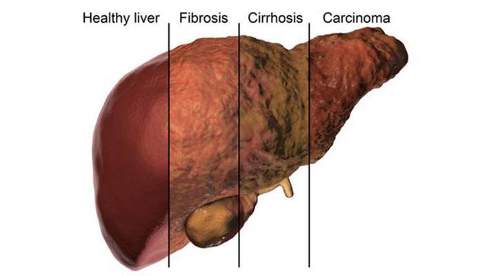 cirrhosis-of-the-liver-symptoms-causes-stages-treatments-new-life