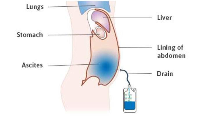 Асцит откачивание жидкости. Дренирование при асците.