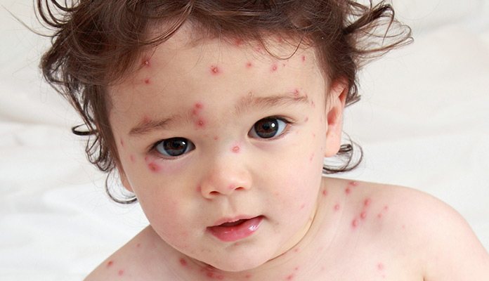 Chickenpox Signs & Symptoms – New Life Ticket