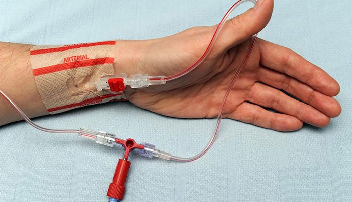 arterial-lines-abnormal-arterial-waveforms-underdampened