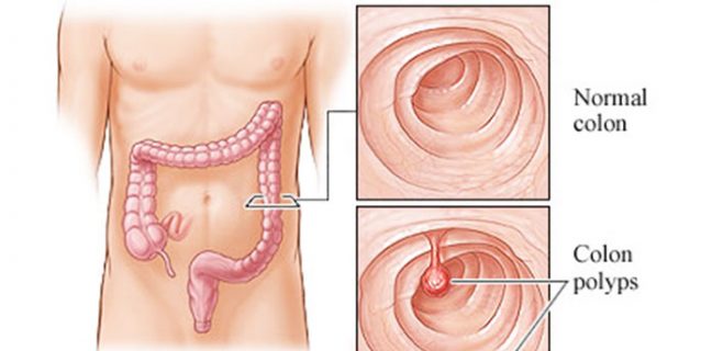 Colon Polyps | New Life Ticket