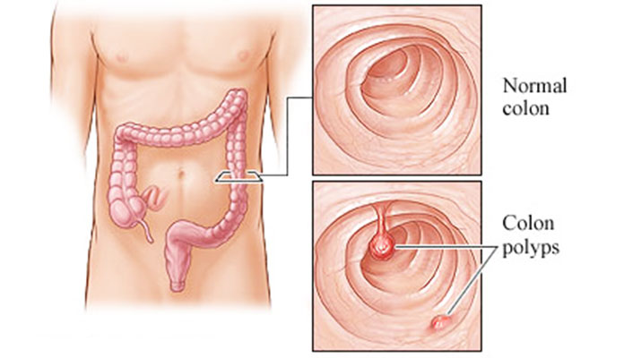 10-causes-of-colon-polyps-new-life-ticket-part-4