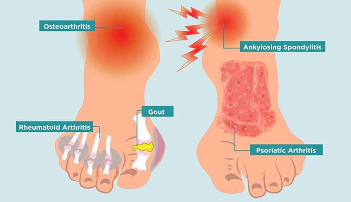 10 Main Causes Of Foot Pain New Life Ticket