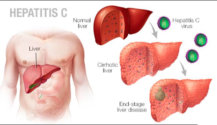 Elevated Liver Enzymes: Causes, Symptoms, and Treatment Tips – Page 2 ...