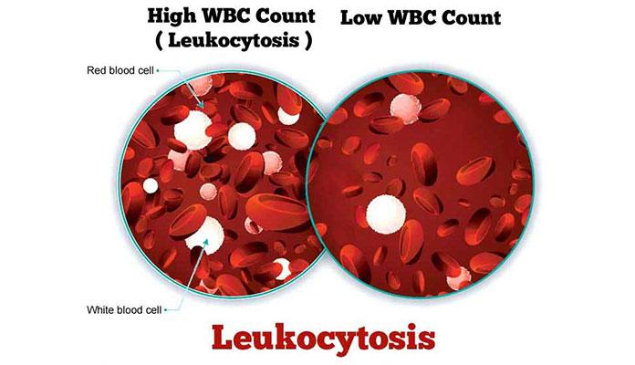 Leukocytosis: Symptoms, Causes and Treatments – New Life Ticket