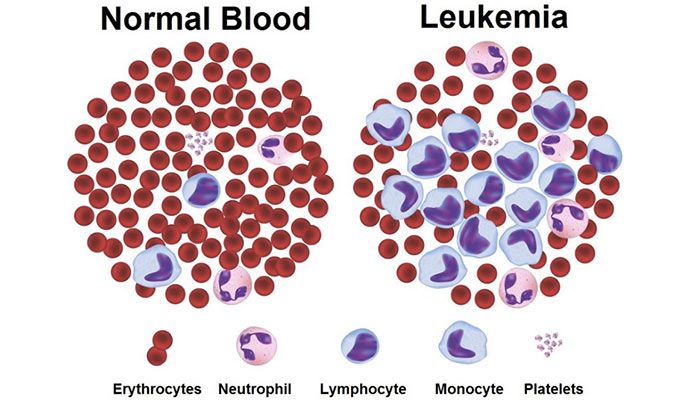 Leukocytosis Symptoms, Causes and Treatments New Life