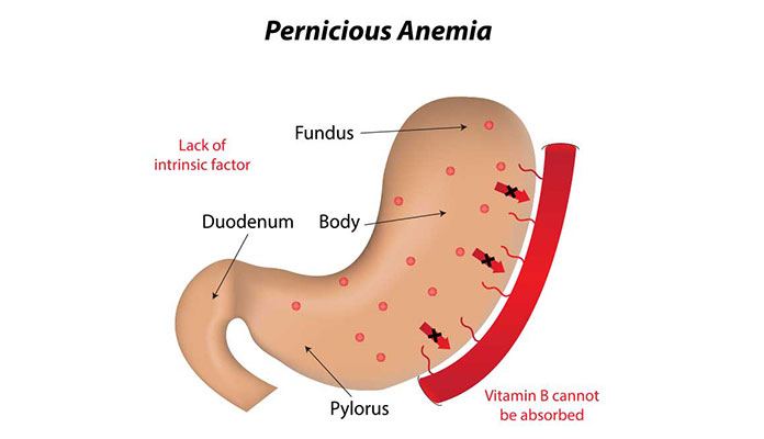 pernicious-anemia-registered-dental-hygienists