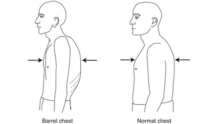 Emphysema Causes & Symptoms – Page 6 – New Life Ticket