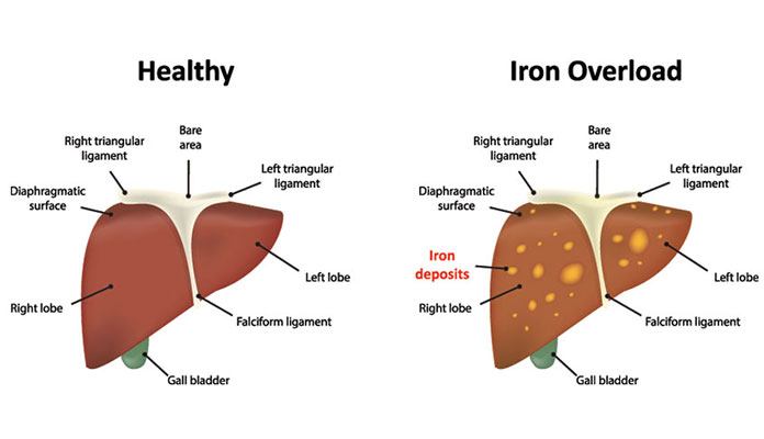 10 Facts about Hemochromatosis – New Life Ticket