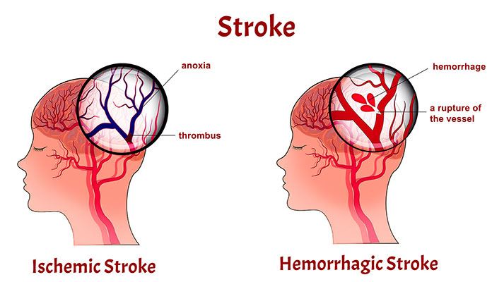 aphasia-causes-symptoms-treatments-new-life-ticket