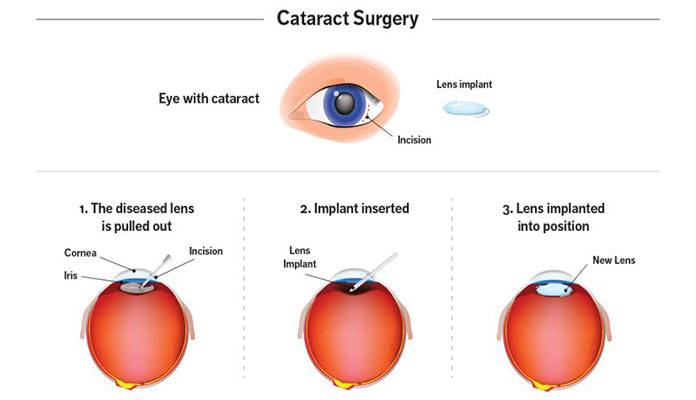 How dangerous is cataract surgery