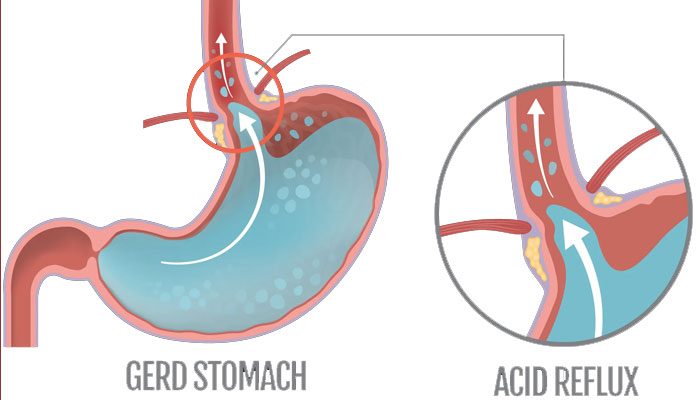 hypothyroidism night sweats