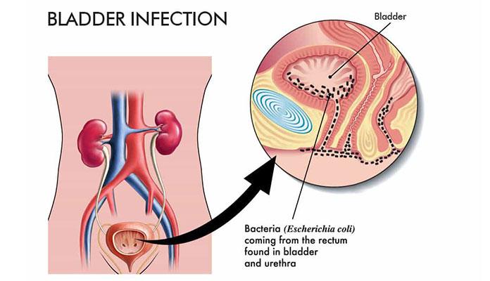 Common Signs Of Bladder Infection New Life Ticket Part 2 0876