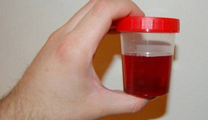 Large Amount Of Blood In Urine