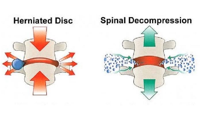 Top 7 Spinal Stenosis Treatments New Life Ticket Part 3