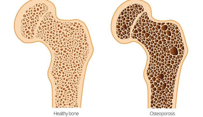 hyperparathyroidism-symptoms-causes-page-7-new-life-ticket