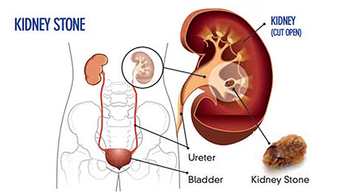 Main Cause Of Kidney Stones