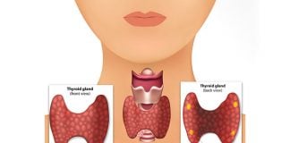 Parathyroid Disease | New Life Ticket