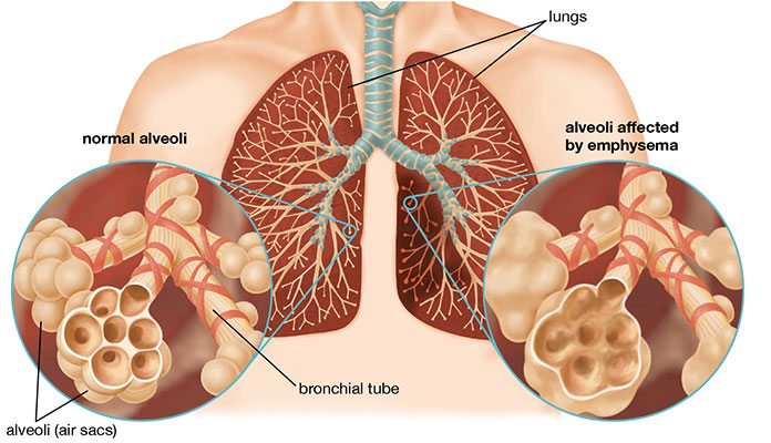 emphysema-stages-life-expectancy-new-life-ticket-part-4