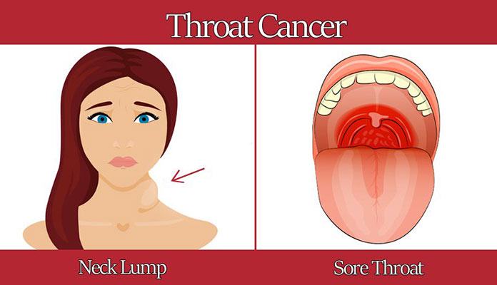 What Does The Back Of Your Throat Look Like   Throat Cancer 