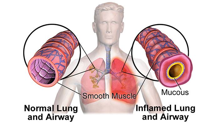 copd-top-10-causes-people-should-know-new-life-ticket-part-9