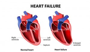 Congestive Heart Failure Stages & Life Expectancy – Page 2 – New Life ...