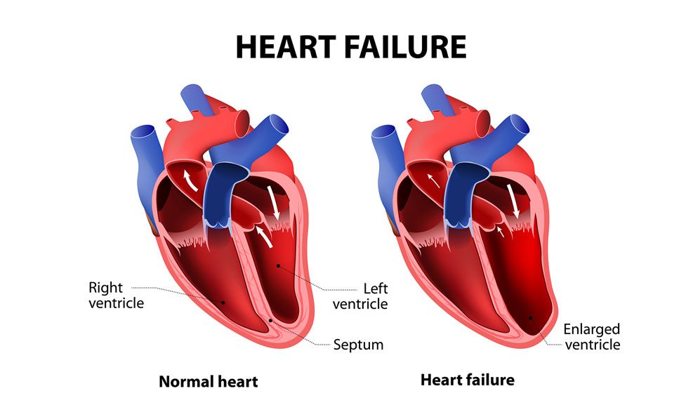 Congestive Heart Failure Stages Life Expectancy New Life Ticket 