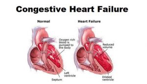 Congestive Heart Failure Stages & Life Expectancy – New Life Ticket