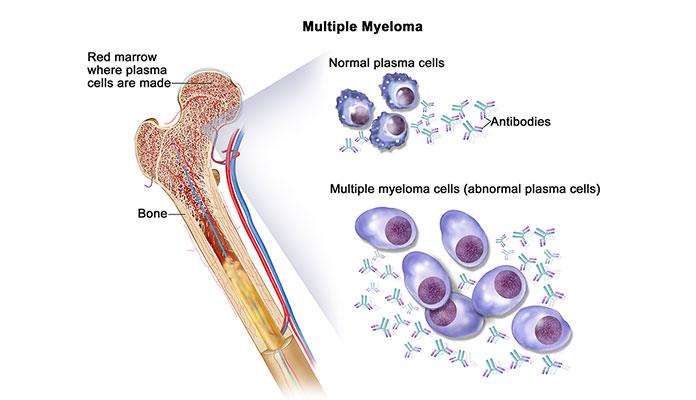Multiple Myeloma – Causes & Risk Factors | New Life Ticket - Part 2