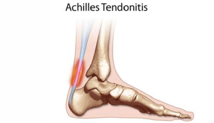 Bump On Achilles Tendon Above The Heel