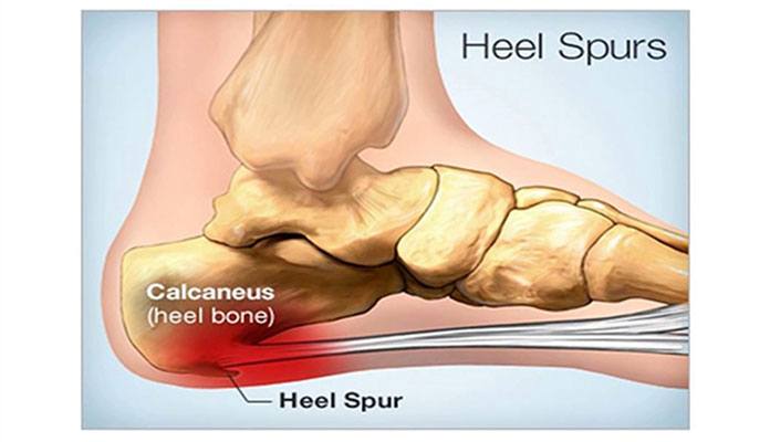 10-causes-of-heel-pain-new-life-ticket-part-2