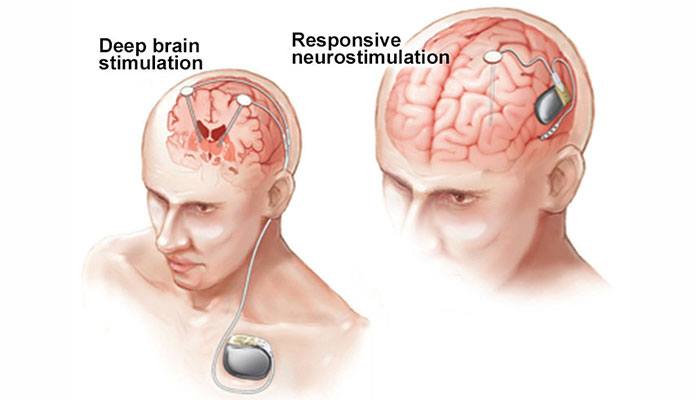 Grand Mal Seizure – Diagnosis & Treatment – Page 9 – New Life Ticket