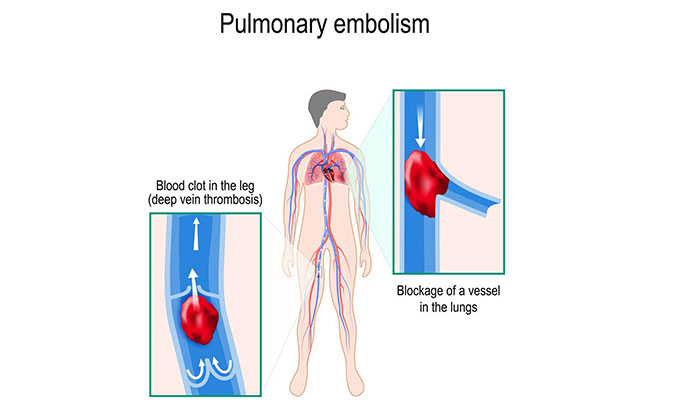 pulmonary-embolisms-symptoms-causes-new-life-ticket