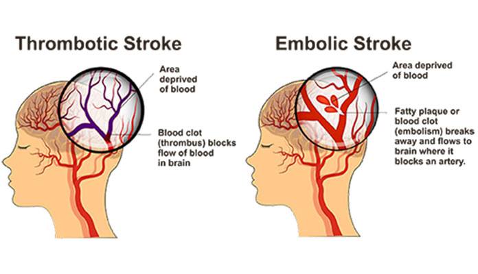 A stroke is when