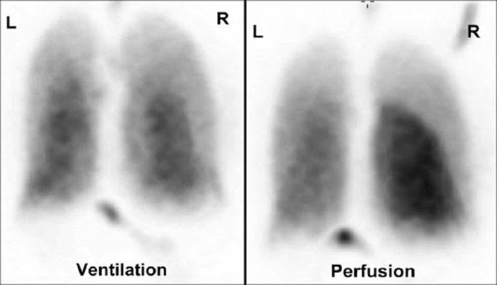 Ventilation Perfusion Scan Pulmonary Embolism