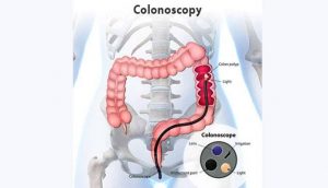 colonoscopy