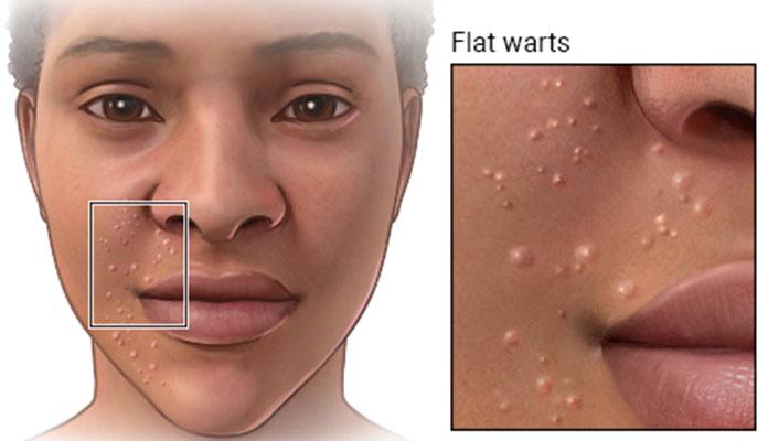 Five Main Types Of Warts New Life Ticket Part 5 