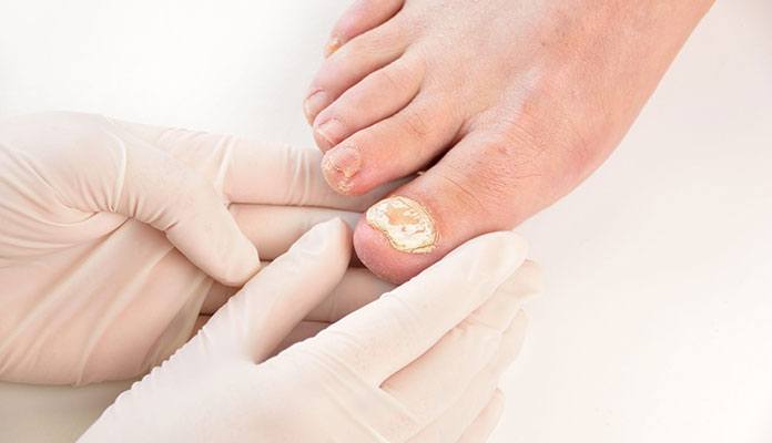 Nail Fungus – Diagnosis And Treatment | New Life Ticket