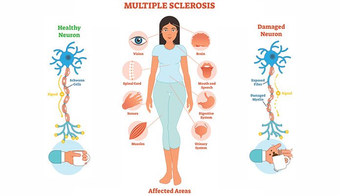 Neuromyelitis Optica vs Multiple Sclerosis – What’s the Difference ...