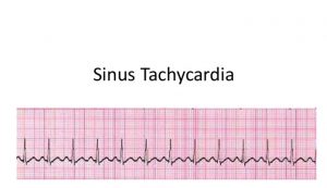 Sinus Tachycardia – Facts to Know – New Life Ticket