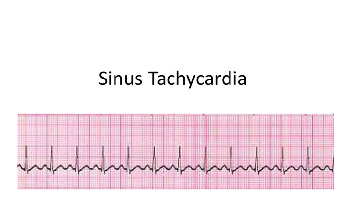 Sinus Tachycardia – Facts To Know – New Life Ticket