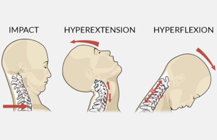 Neck Pain – Symptoms and Causes – Page 3 – New Life Ticket