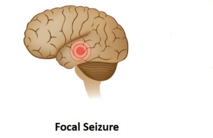 partial-seizures-focal-seizures-guide-10-facts-to-know-page-2