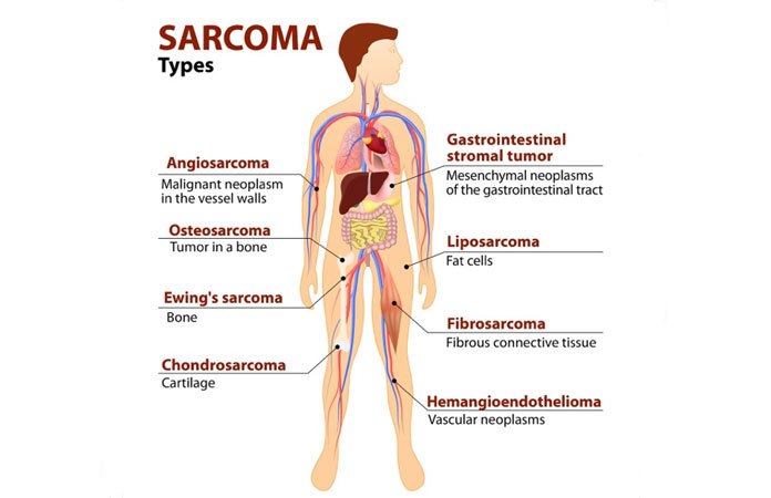 What is Sarcoma – 10 Facts to Know | New Life Ticket - Part 2