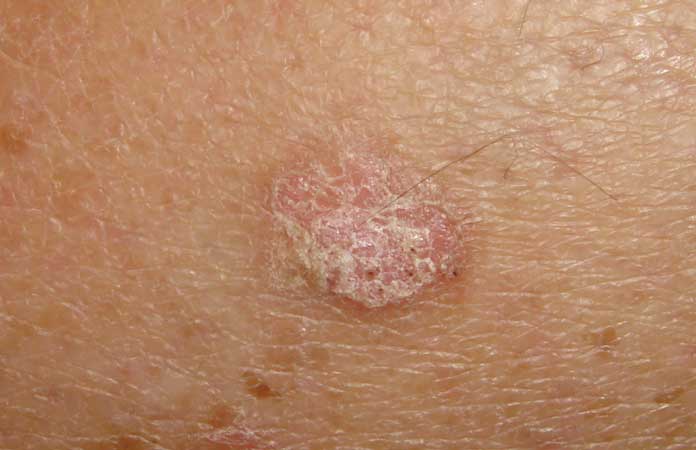 common-skin-cancer-types-page-2-new-life-ticket