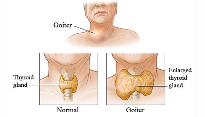 Goiter Enlarged Thyroid Symptoms And Causes New Life Ticket