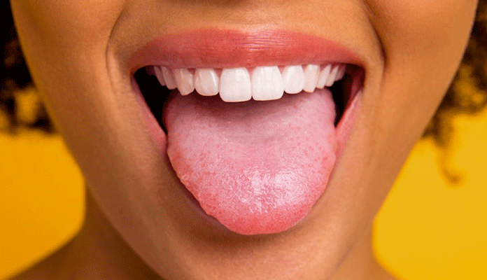 Strep Throat Bumps On Tongue Pictures